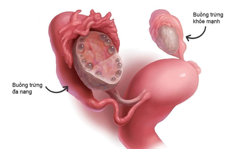 chế độ ăn keto cho người buồng trứng đa nang